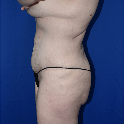 Abdominoplasty