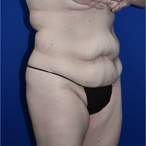 Abdominoplasty