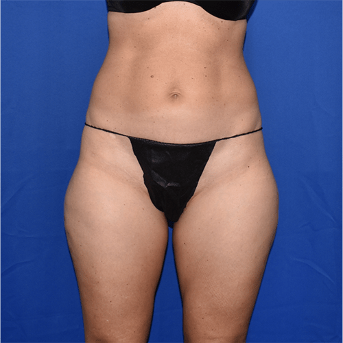 Liposuction