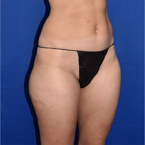 Liposuction