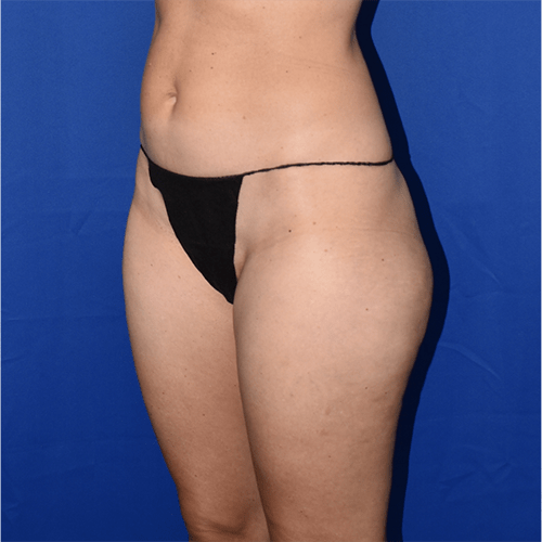 Liposuction