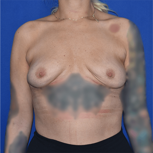 Breast Implant Removal