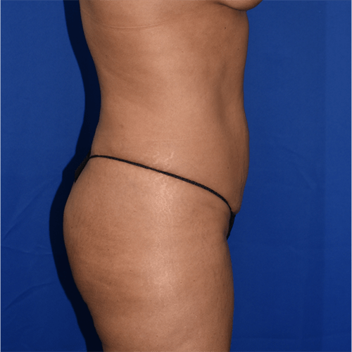 Abdominoplasty