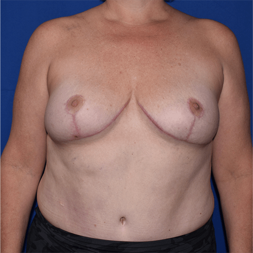 Breast Reduction