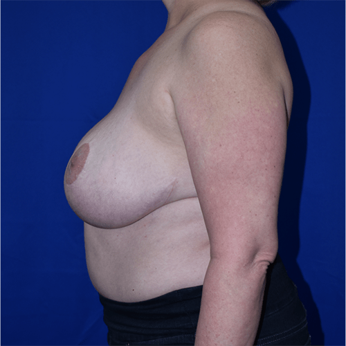 Breast Reduction