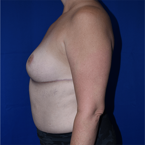 Breast Reduction