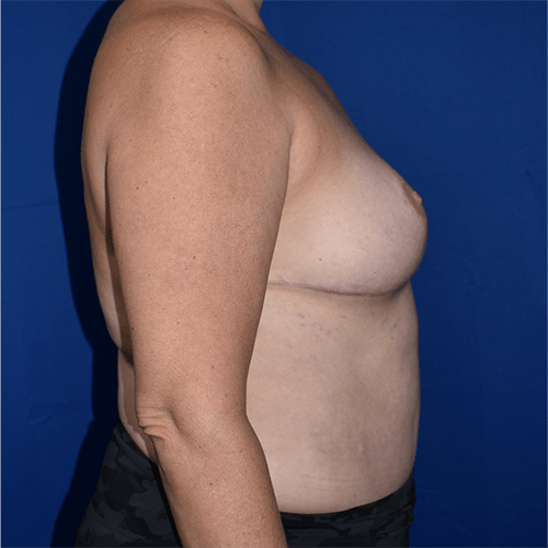 Breast Reduction