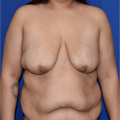 Breast Augmentation With Lift