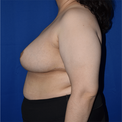 Breast Reduction