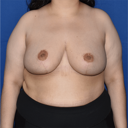 Breast Reduction