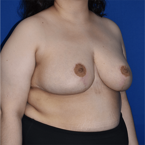 Breast Reduction