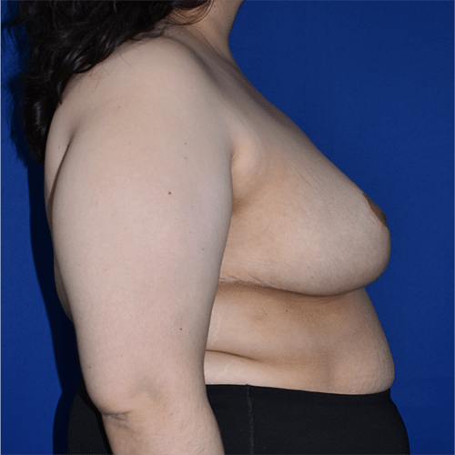 Breast Reduction