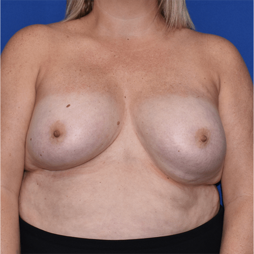 Breast Implant Removal