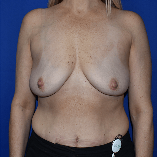 Breast Implant Removal