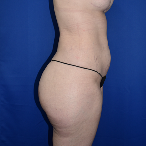 Liposuction