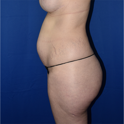 Liposuction